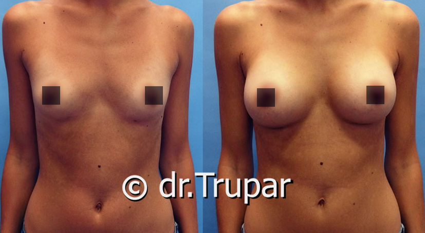 Fotky před a po zvětšení prsou