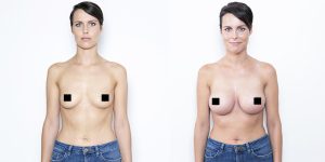 Popisek: Fotky před a po augmentaci klientky MEDICOM CLINIC Praha, operoval MUDr. Petros Christodoulou. (zdroj: medicomclinic.cz/)
