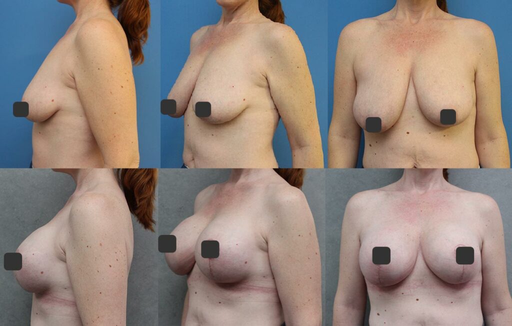Modelace s augmentací pod prsní žlázu, vybraná velikost 385 ml, vysoký profil, polyuretanový povrch