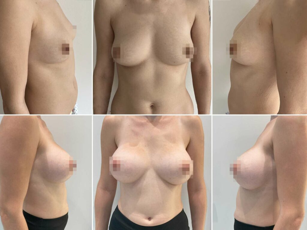 prsní implantát o velikosti 315ml - submuskulárně z podprsní rýhy.